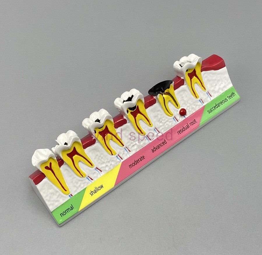 New Dental Study Teaching Models Caries Disease Assort Teeth Dentoform Model
