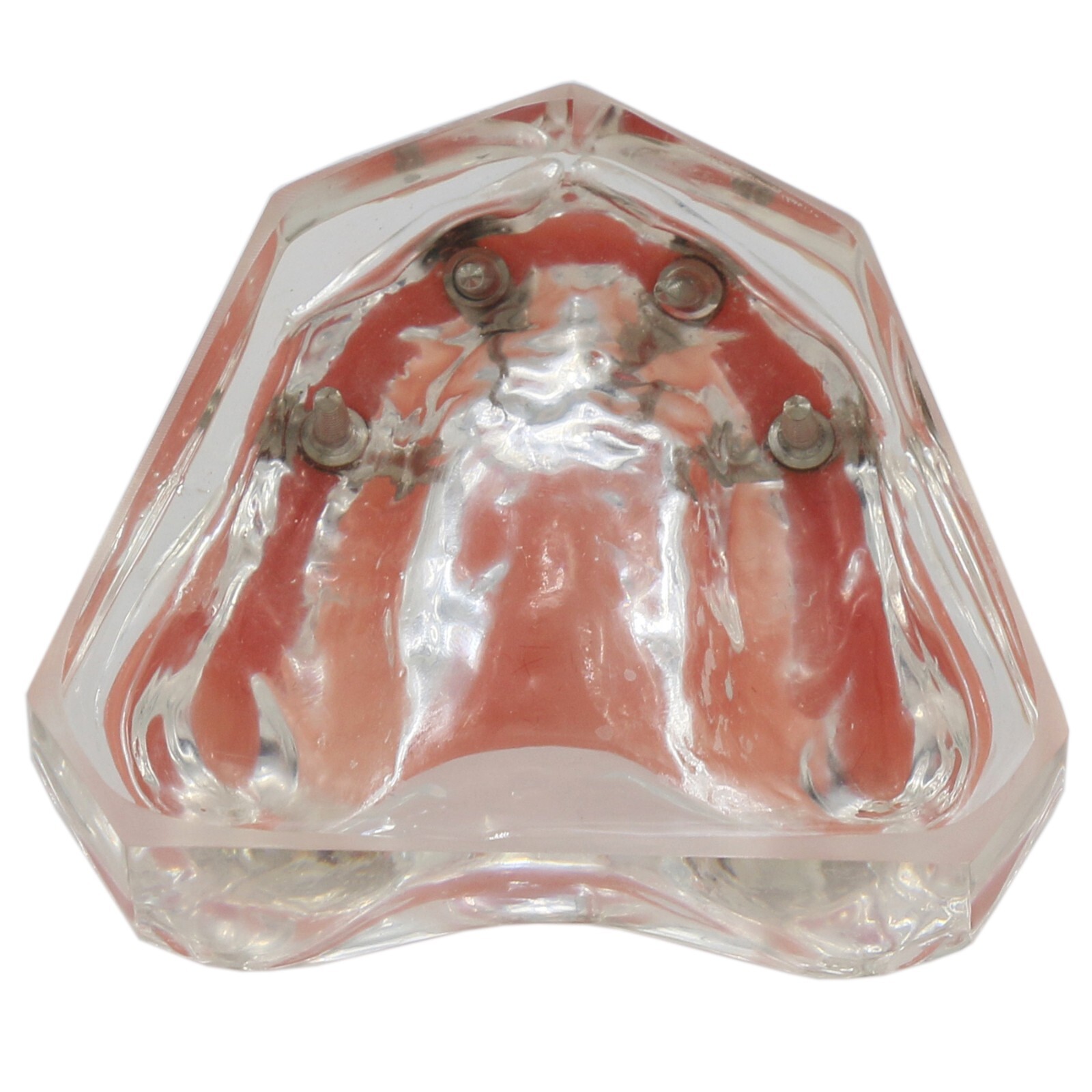 US Dental Implant Teeth Model Overdenture Restoration With4 Implants Upper Lower