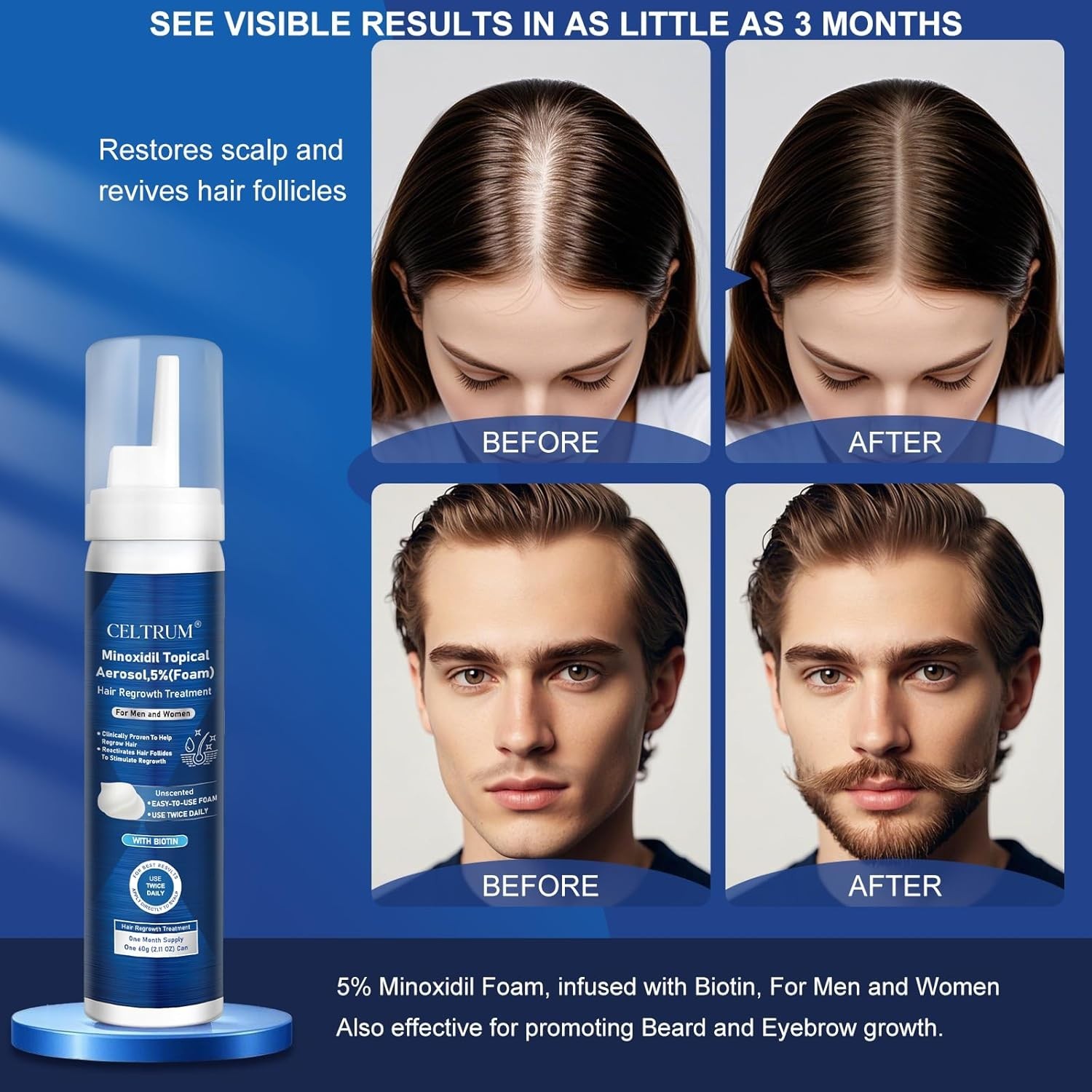 5% Topical Minoxidil Foam, Minoxidil for Men and Women, Infused with Biotin, Hai