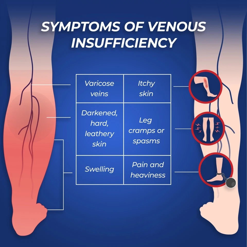 VenEase Vein Support Supplements - Restless Legs Formula Sup