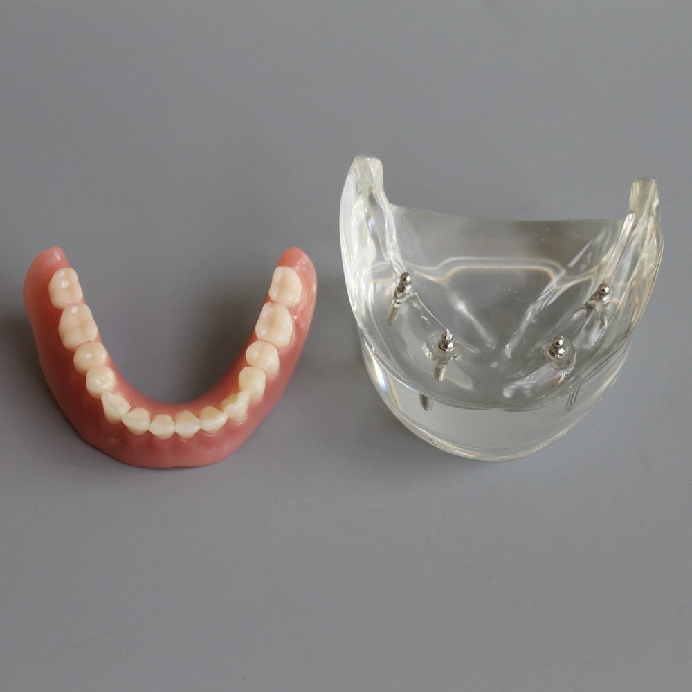 1 PC Dental Overdenture Inferior Teeth Model 4 Implants Restoration Lower M6003