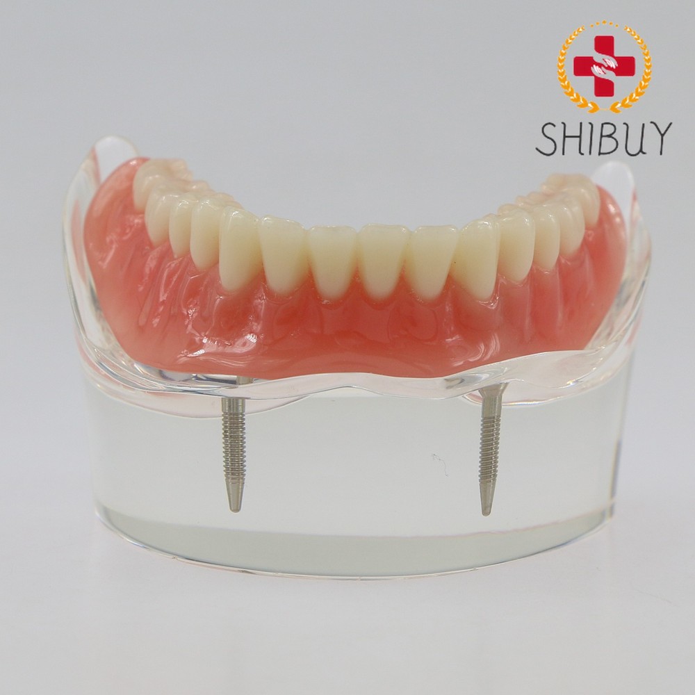 M6002 Dental Overdenture Inferior with 2 Implants Demo Model