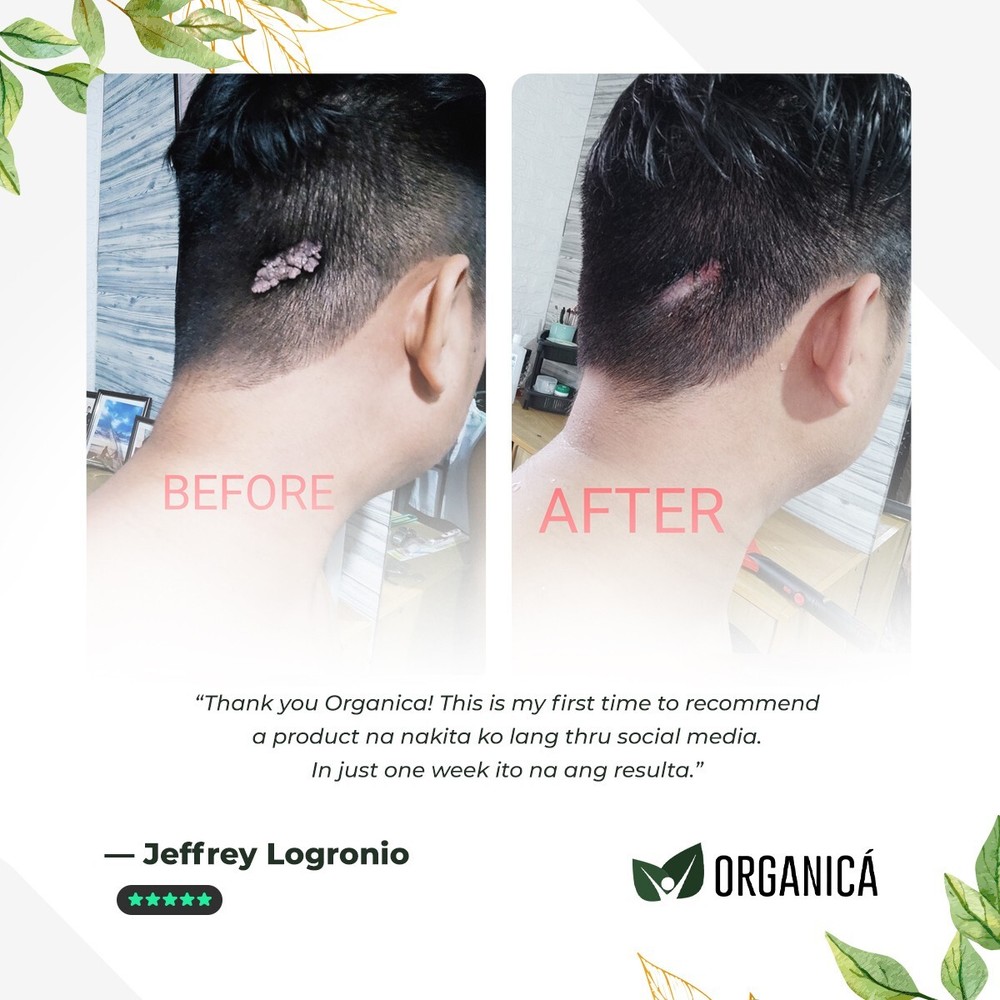 Multi-Awarded Mole and Warts Remover Set