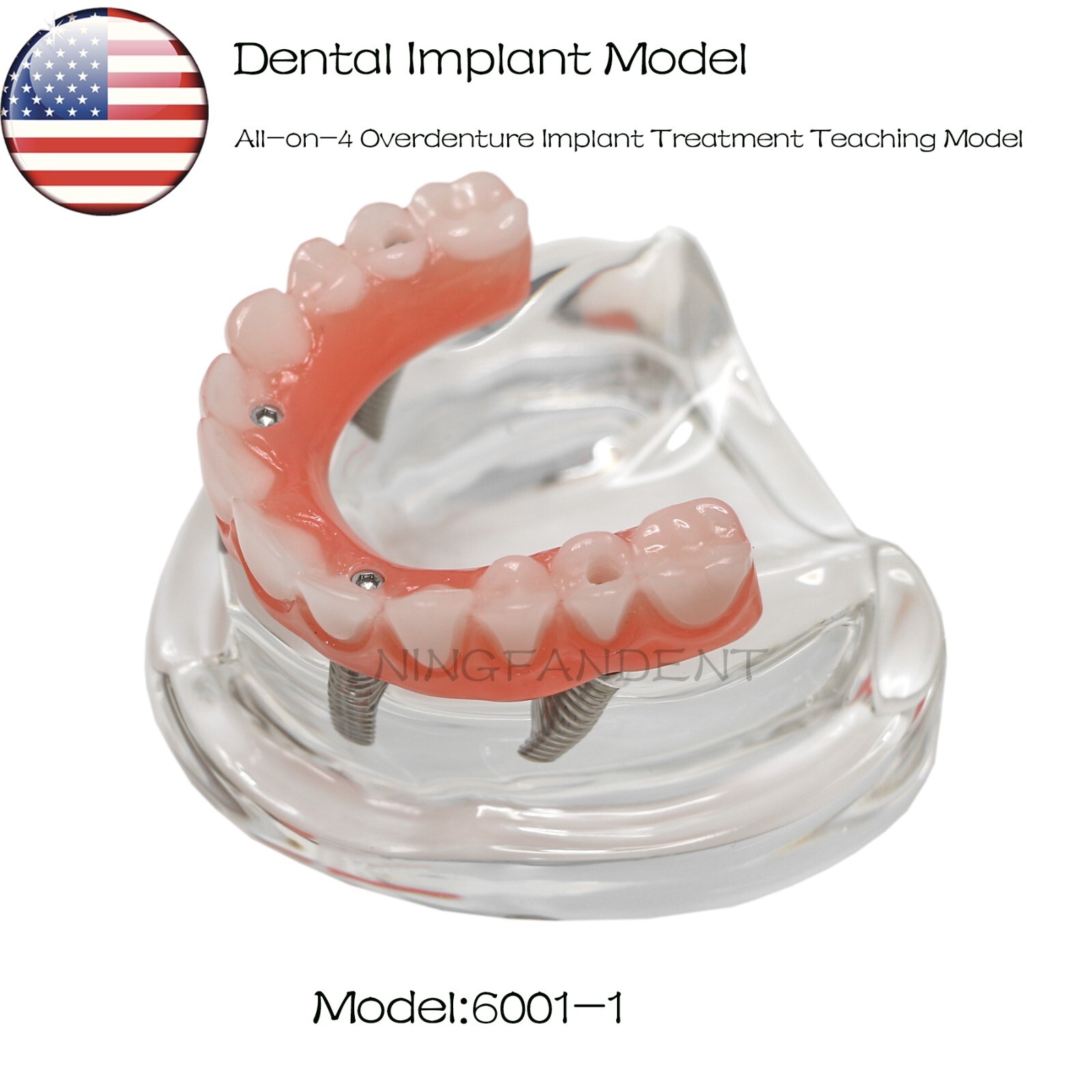 US Dental All-on-4 Overdenture treatment Implant Model Upper 4 Implants Clear