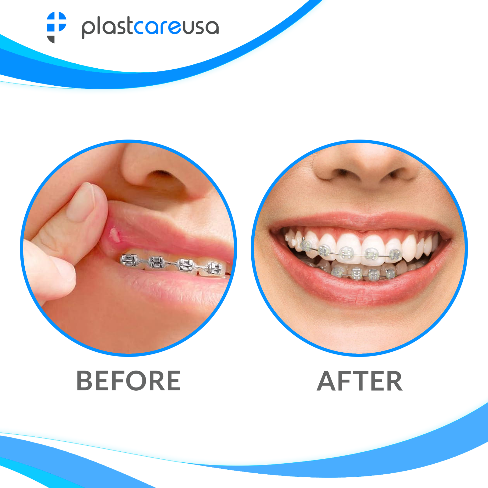 50 Braces Wax for Dental Orthodontic Teeth Protection - Bulk Ortho Unscented Kit