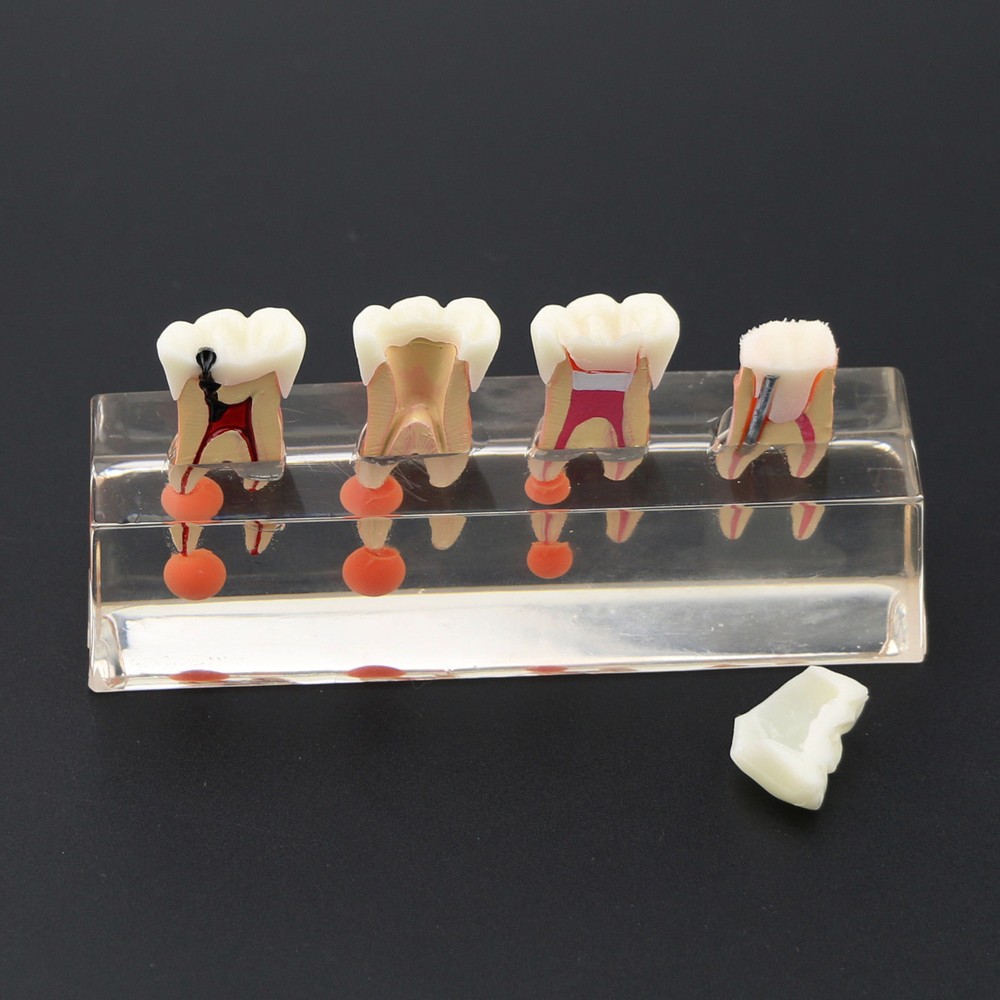 1 Set Dental Teeth Model #4018 01 - 4-Stage Endodontic Treatment Study Model