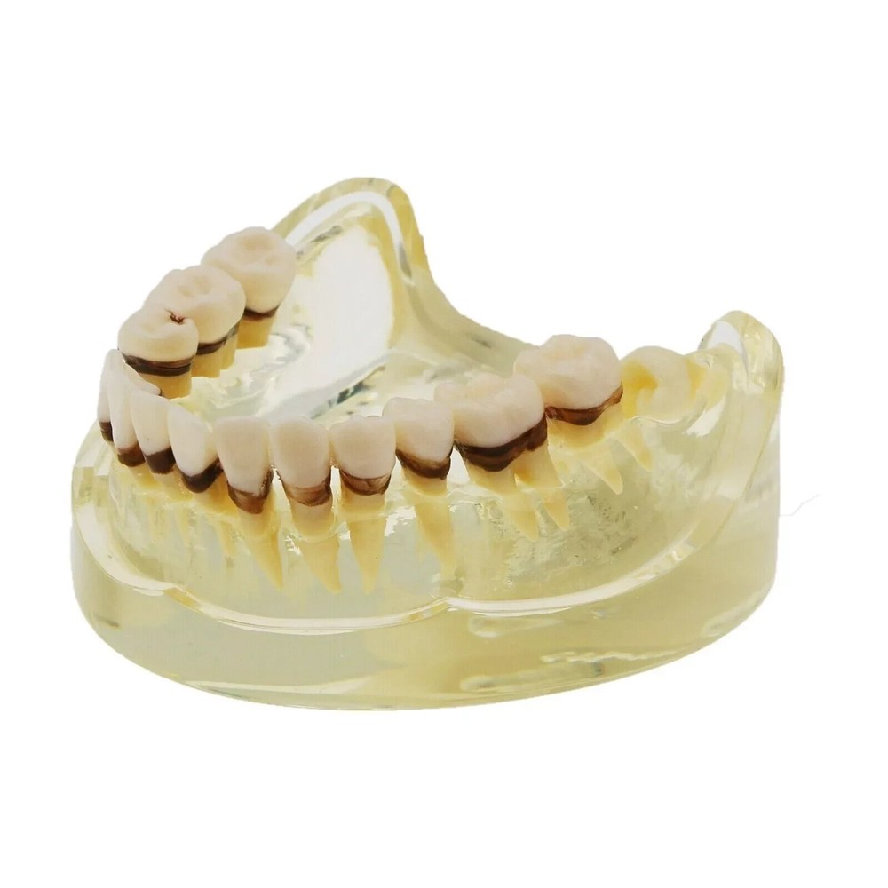 Dental Teeth Model Pathological Disease M4017 Removable Teaching Study Model