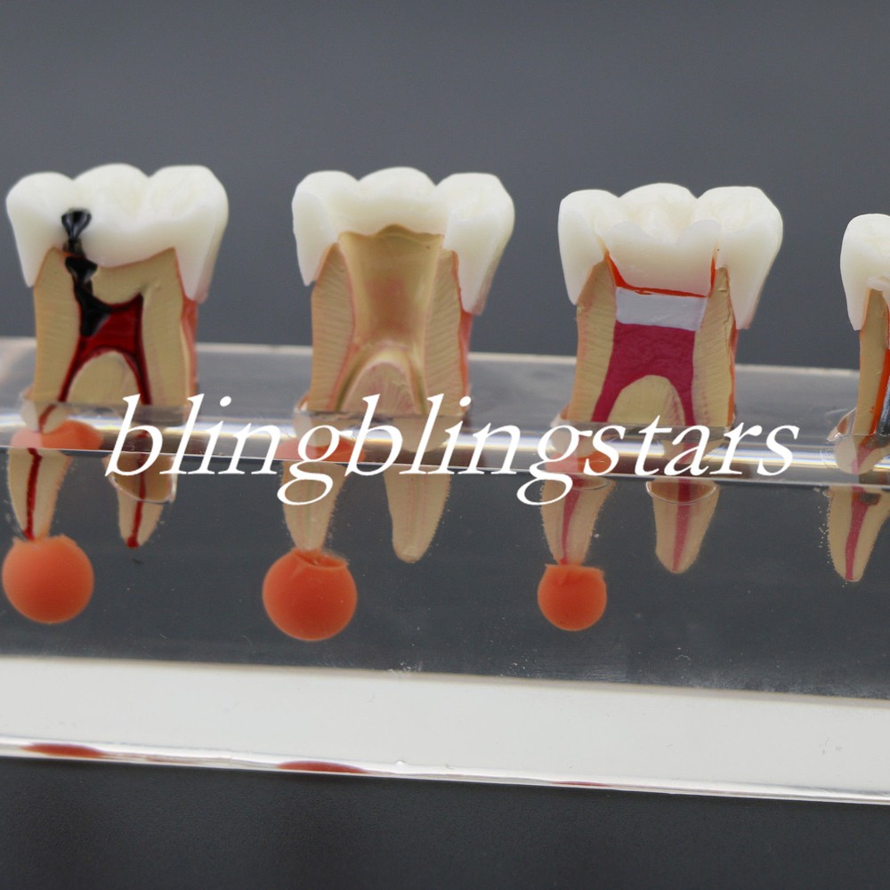 Dental Teeth Model Treatment Demonstrates Model 4 Stages Endodontic Study 4018