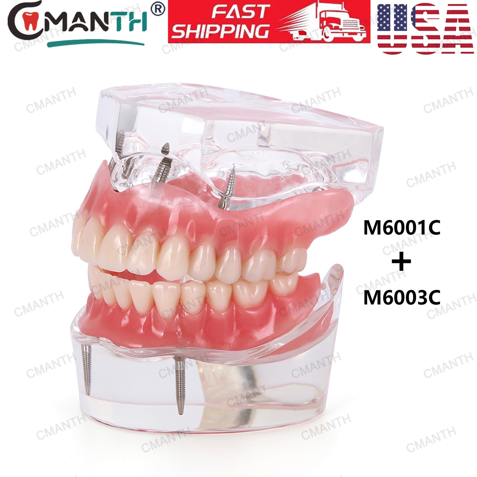 US Dental Implant Teeth Model Overdenture Restoration With4 Implants Upper Lower