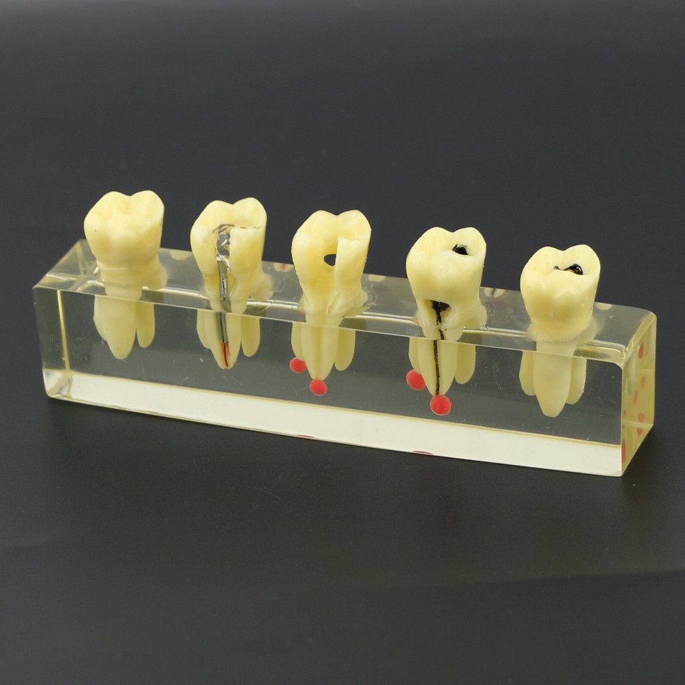 Dental Typodont Caries Teeth Model Root Canal Endo Pathological Study Demo Model