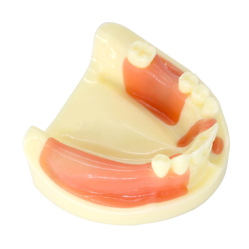 Dental Study Model with Bone Resorption & Missing Teeth for Implant Training