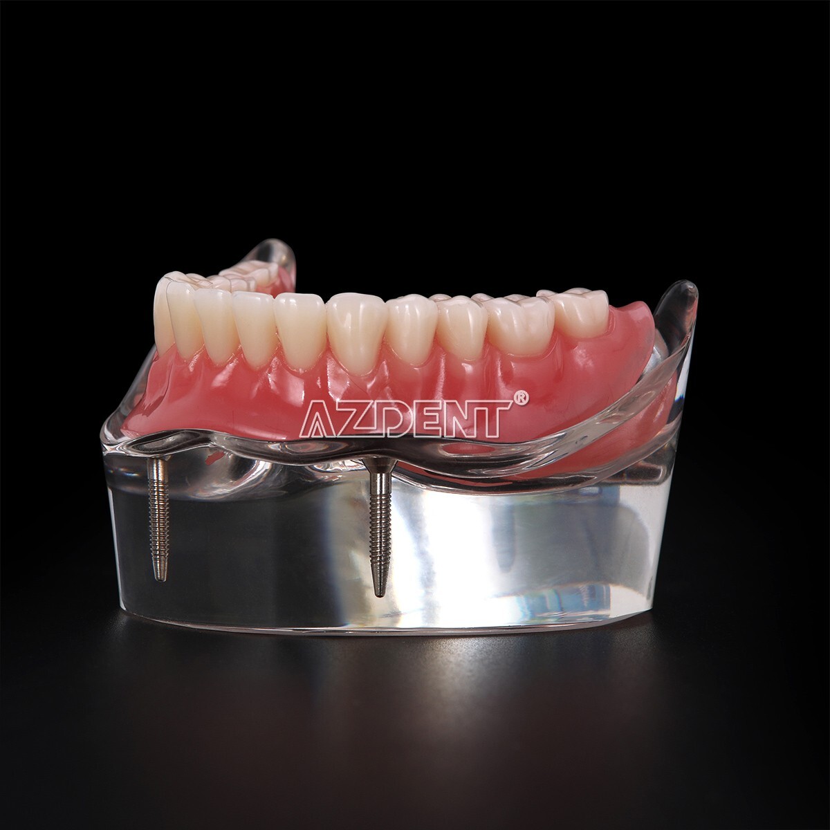 Dental Implant Teeth Model Demo Overdenture Restoration With Implants Lower