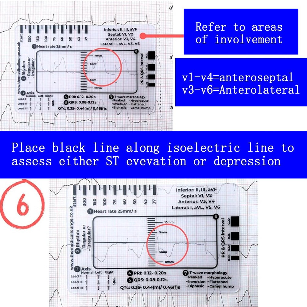 3Pcs ECG 7 Step Ruler EKG Interpretation Plastic Measuring Tool Transparent