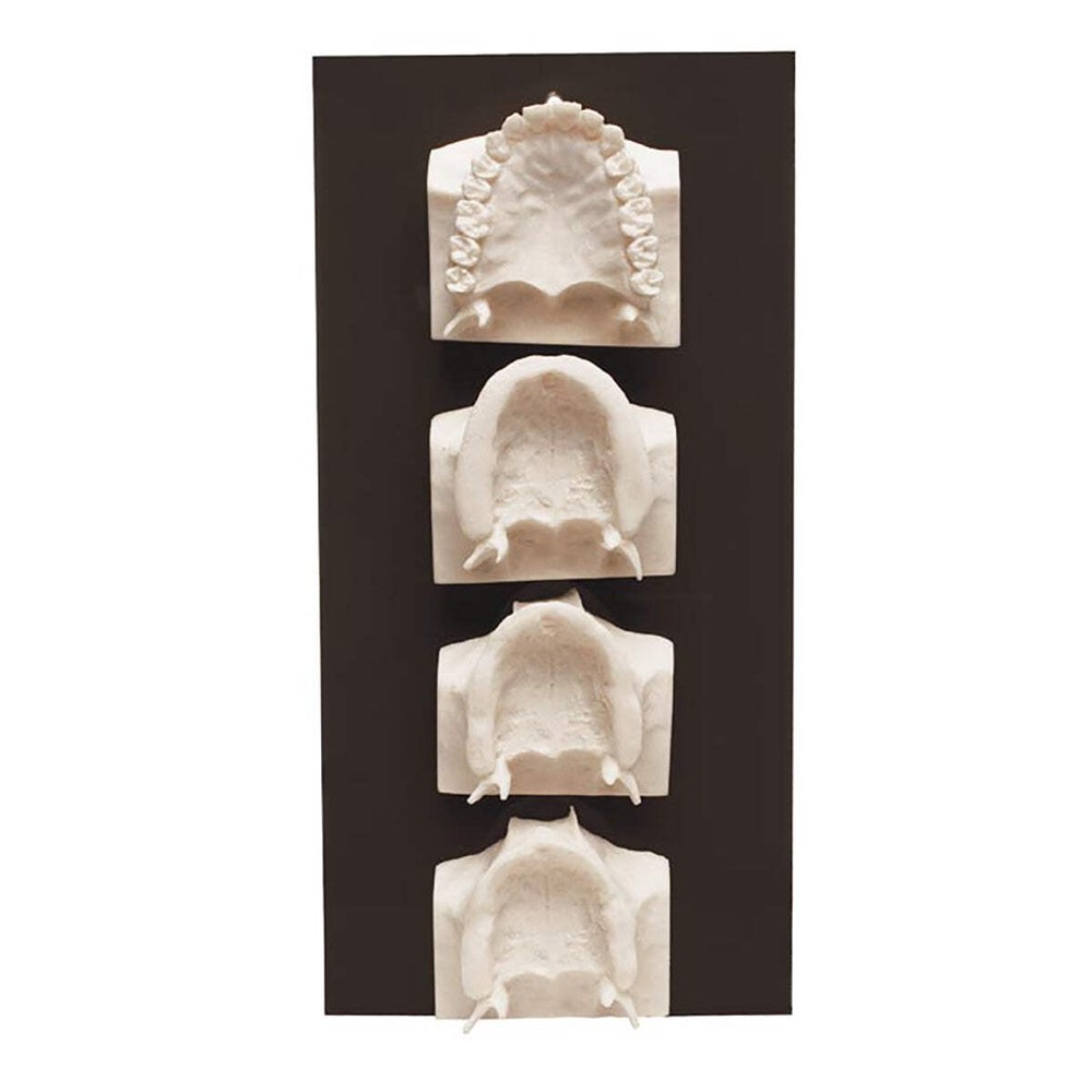 Maxilla Bone Loss Model