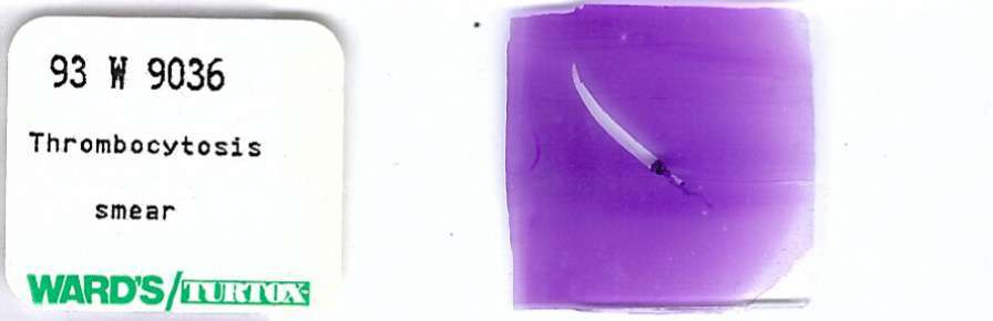 Thrombocytosis Smear Pathology Microscope Slide