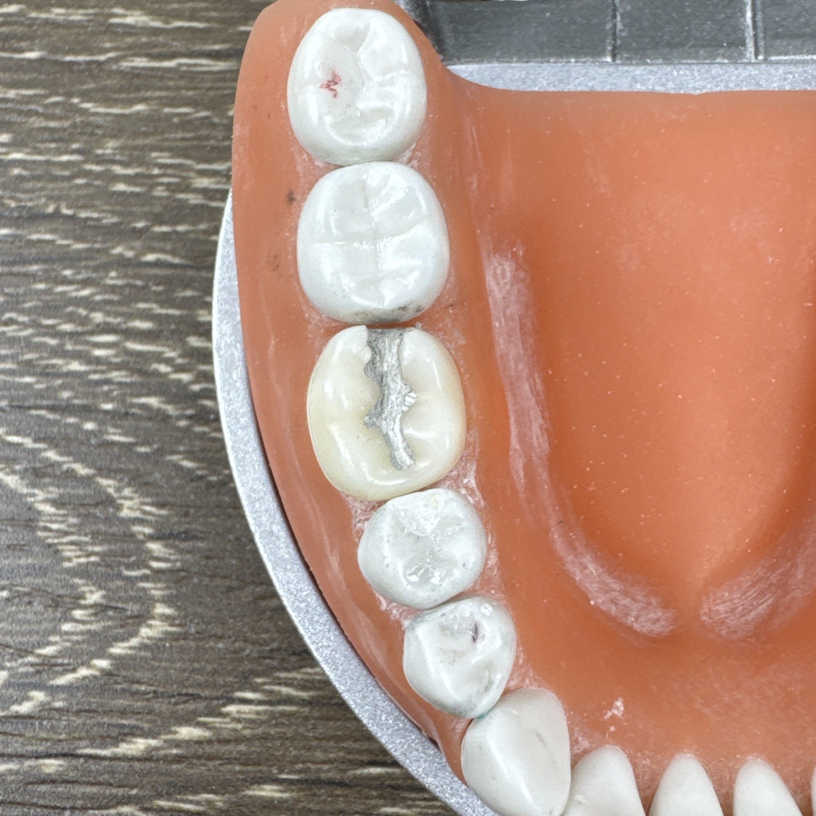 Acadental ModuPRO MP_R320 Restoration Typodont & Case WREB CDCA ADEX Teeth #54