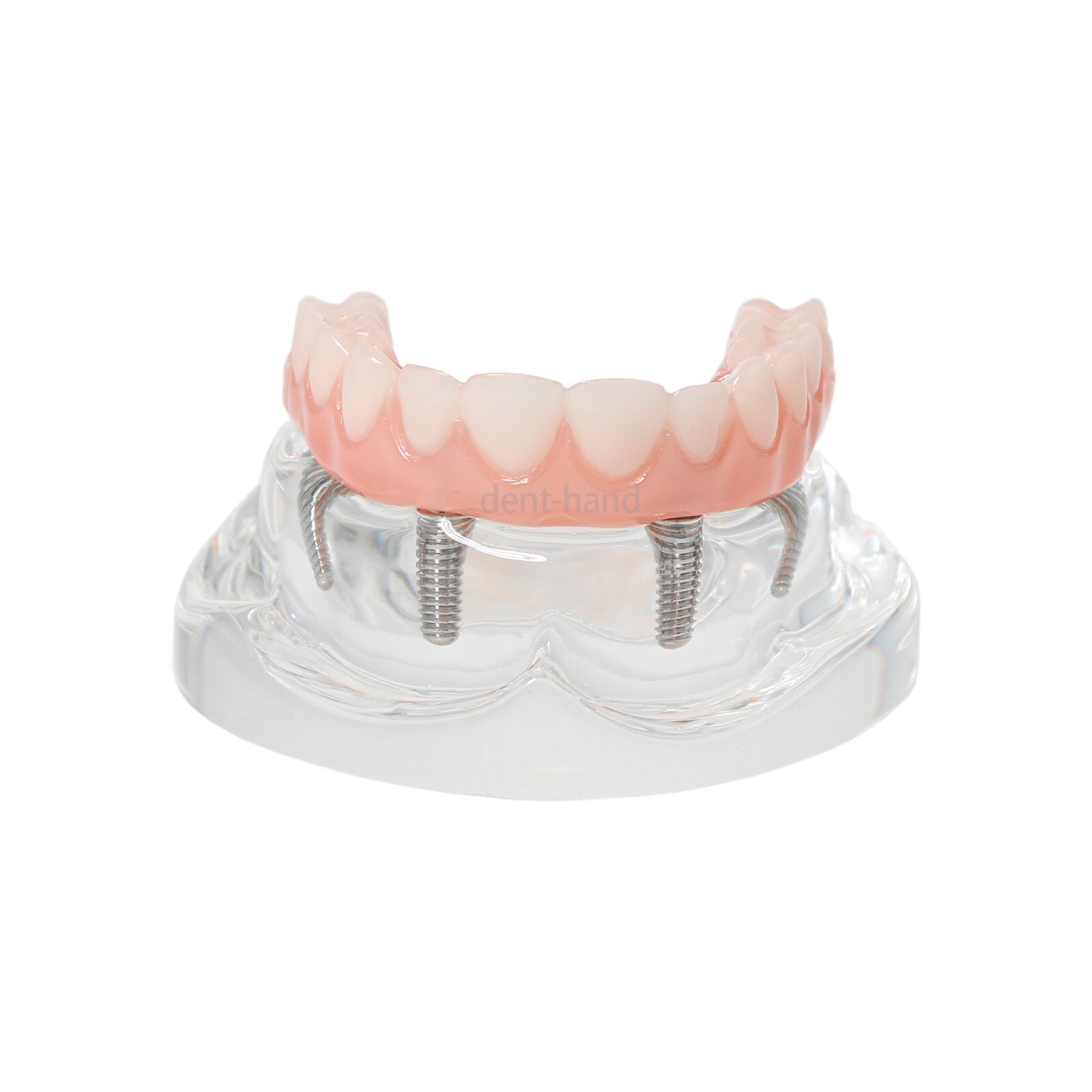 Dental Upper/Lower 4 Implants Demo Implant Teeth Model Restoration Overdenture