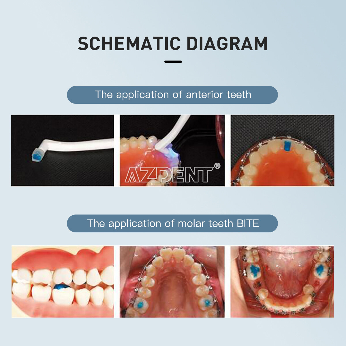 Dental Orthodontic Adhesive Light Cure Band Cement Blue Glue Kit for Brace