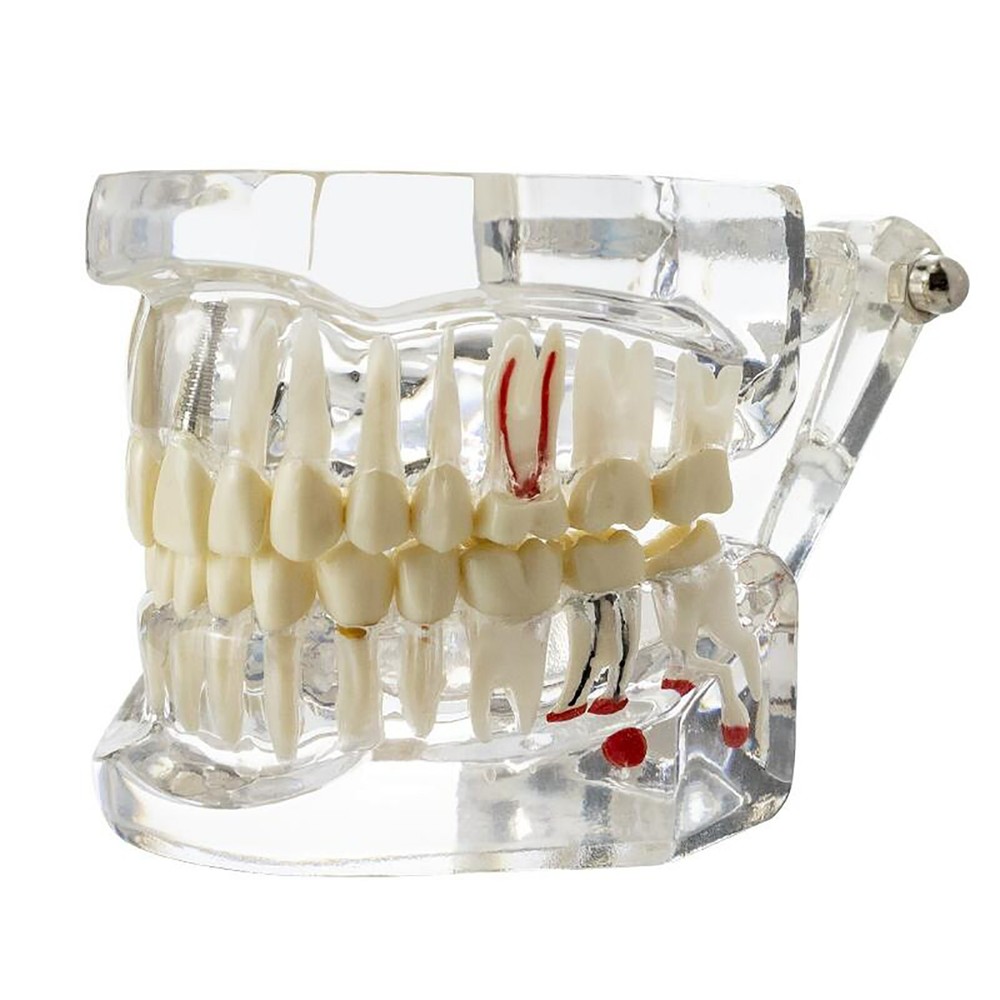 Dental Removable Restoration &Implant Pathological Disease Teeth Study Model