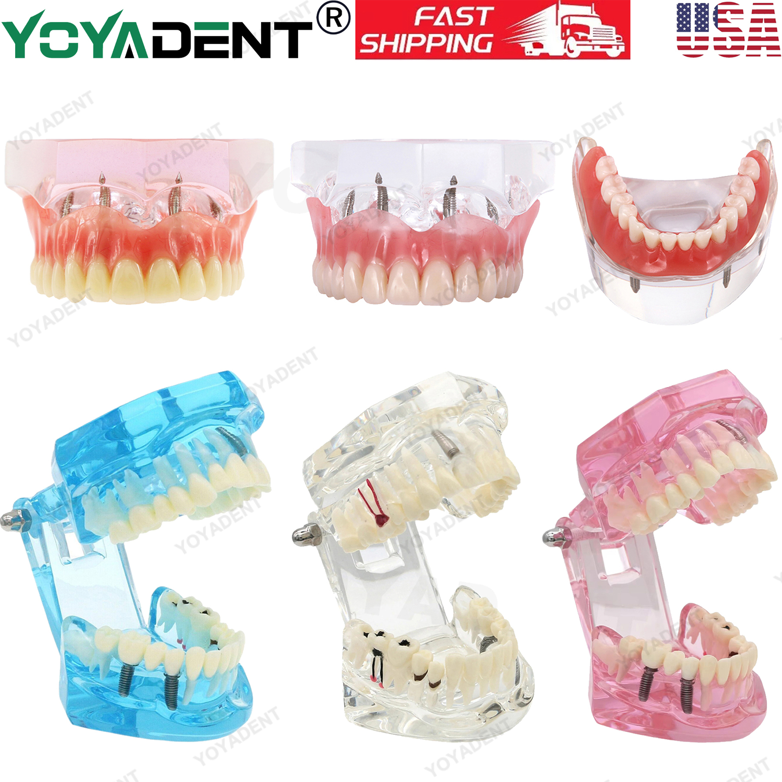 US Dental Teeth Model Ortho Implant Practice Teaching With Implants Demo Model