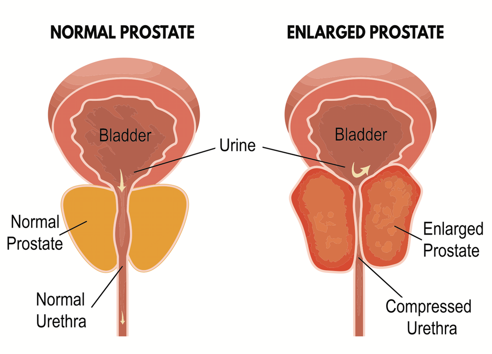 prostate supplement-PROSTATE SUPPORT Advanced Complex-1B- anti-inflammatory