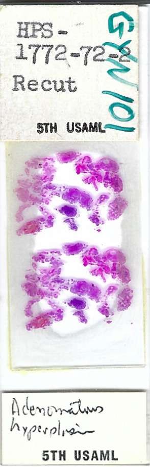 Human Adenomatous Hyperplasia Endometrium Pathology Microscope Slide