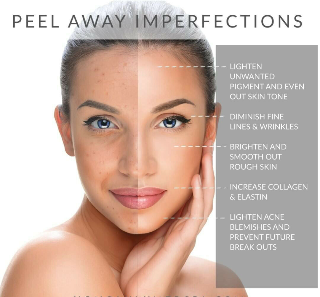 Lactic Acid Skin Peel For Acne Wrinkles Melasma Age Spots 25% 40% 50% 90%