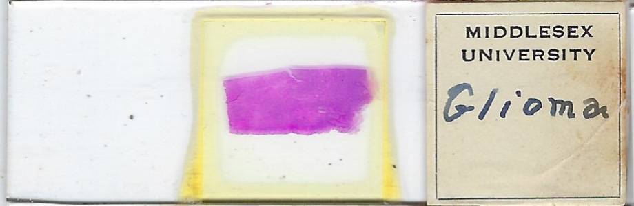 Human Glioma Pathology Microscope Slide