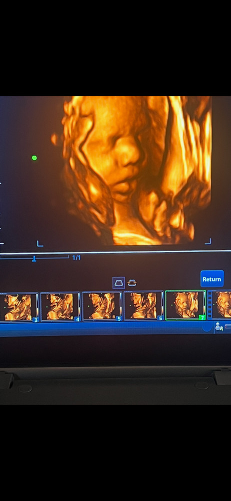 2022 ultrasound machine mindray z6