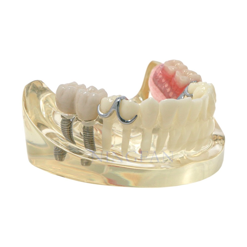 Dental Typodont partial denture Model RPD Demo Retainer WIth 2 Implants