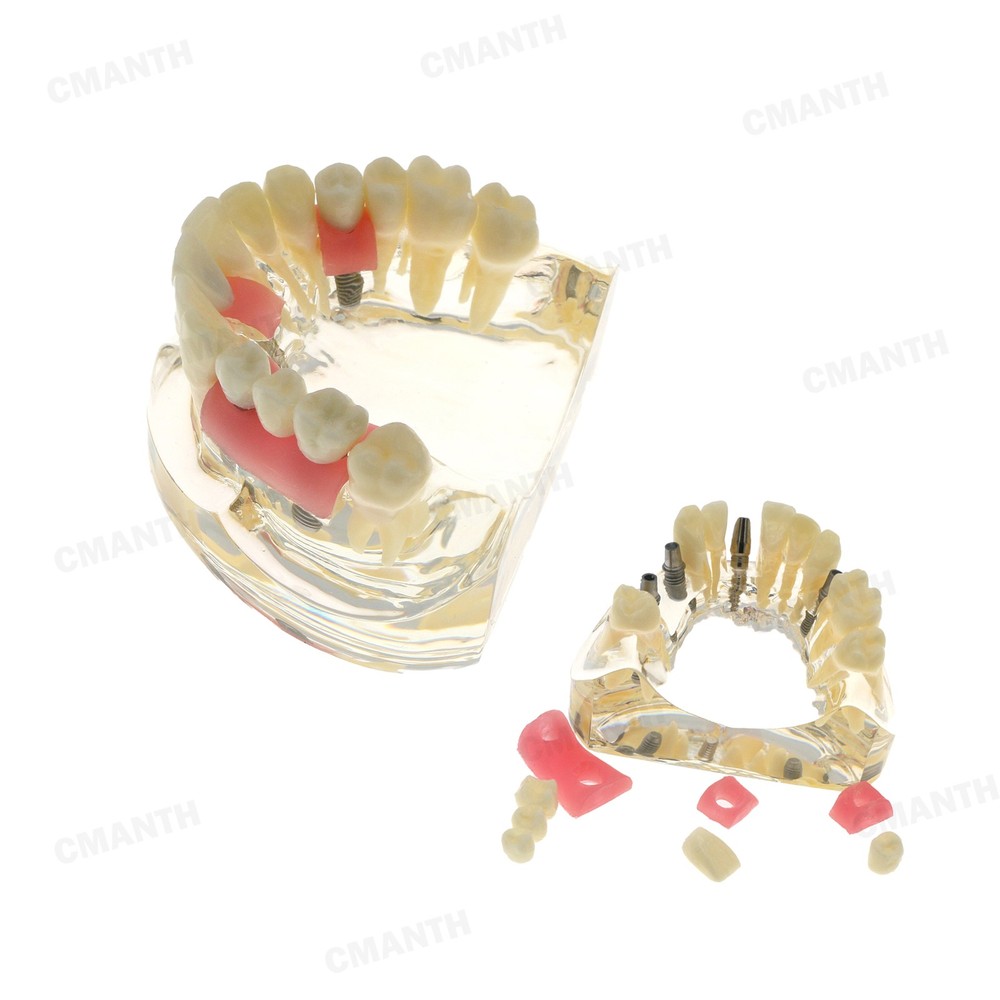 Dental Teeth Pathological Perio Practice Implant Model Studying Teaching M2005
