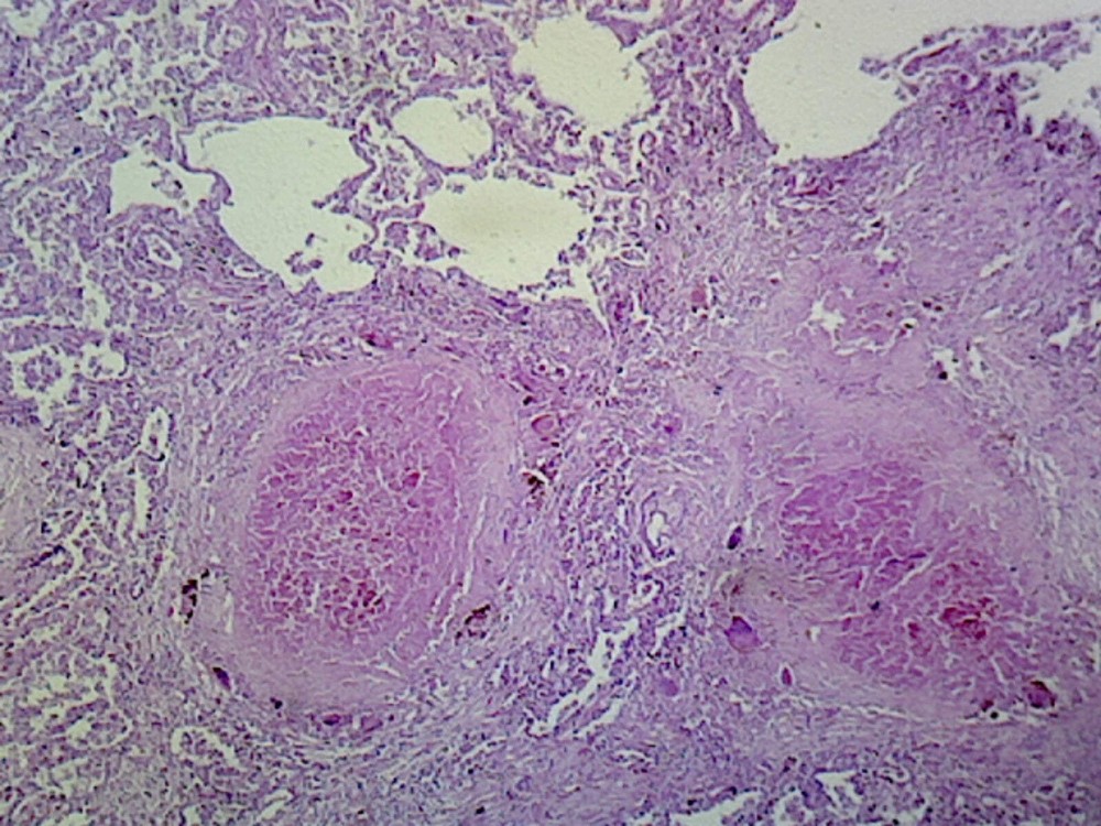Lung Tuberculosis (Human Respiratory System); Section; H&E Stain