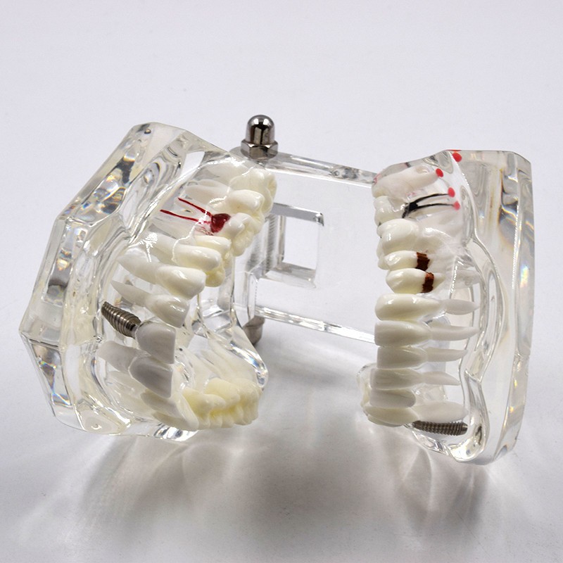Dental Removable Restoration &Implant Pathological Disease Teeth Study Model