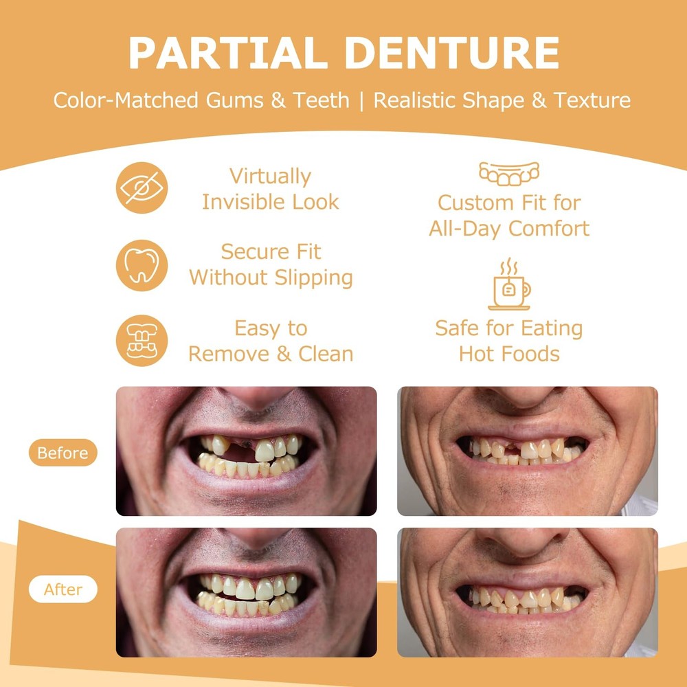 Partial Dentures - for Missing Teeth & Gaps - 1 Tooth, White