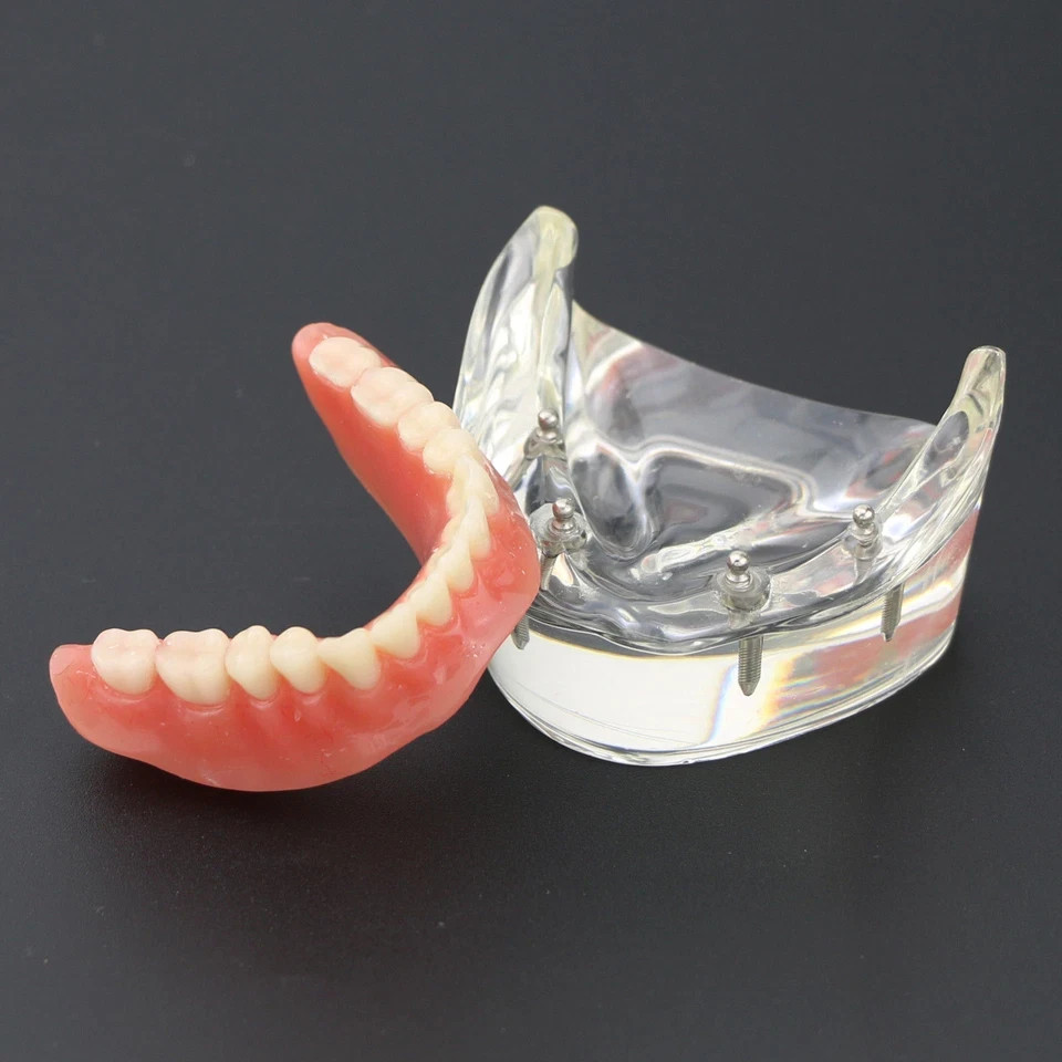 Dental 2/4 Implants Upper Lower Teeth Model Lower Demo Overdenture Restoration