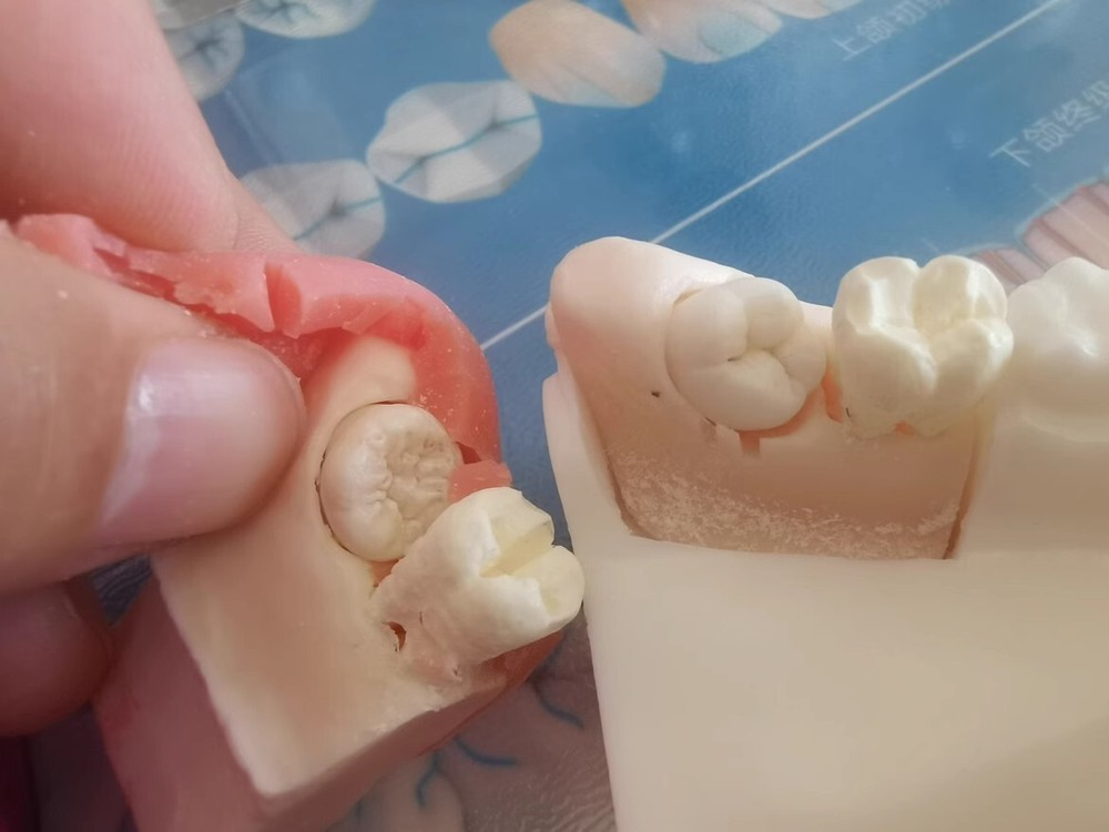 Dental Impacted Tooth Extraction Practice Model Dental Training Display