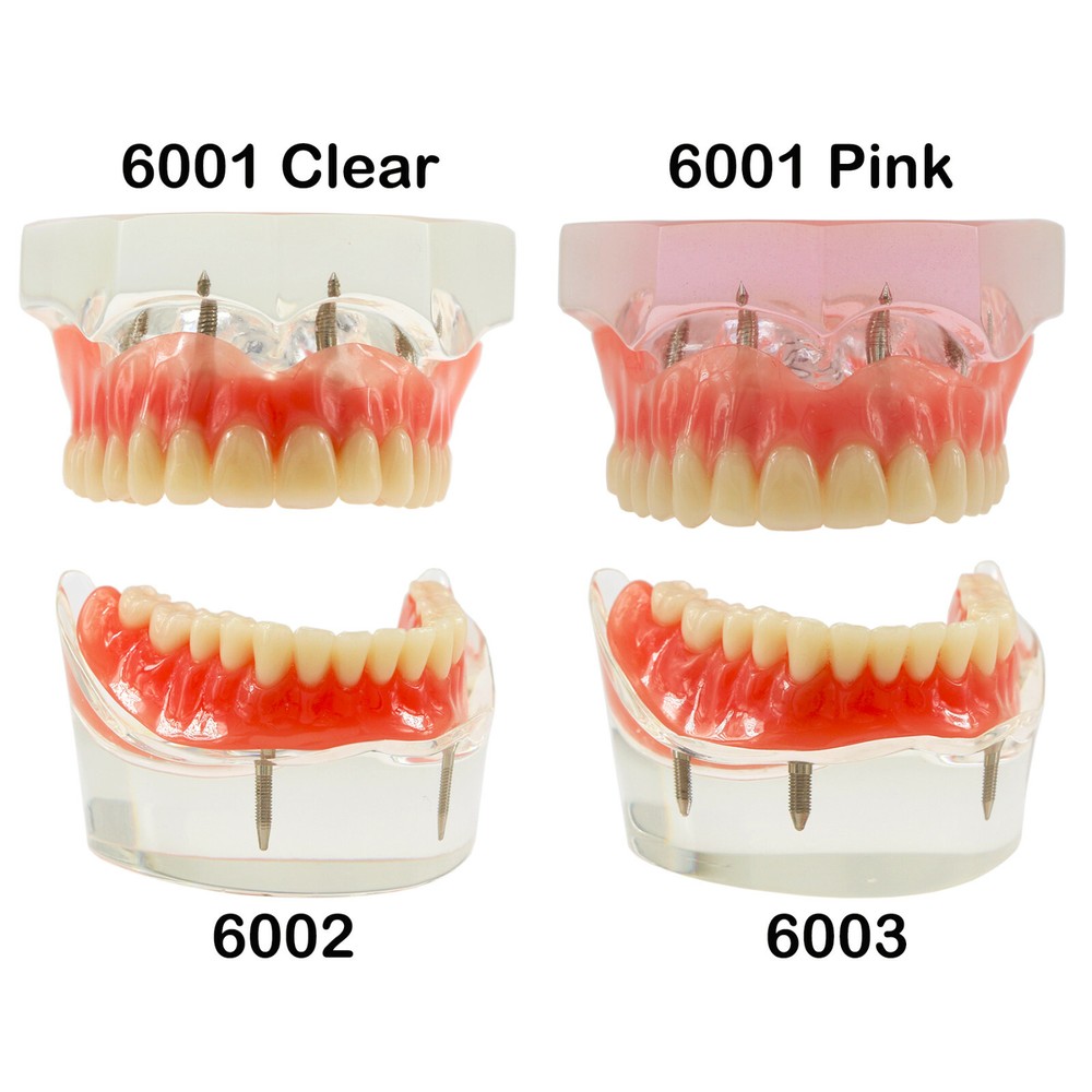 Dental Ortho Teeth Model Implants Practice Teaching Restortion Brushing Model