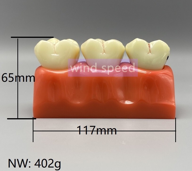 Dental Teaching Model 4 Times Caries Disassembling Comparations Implant Model