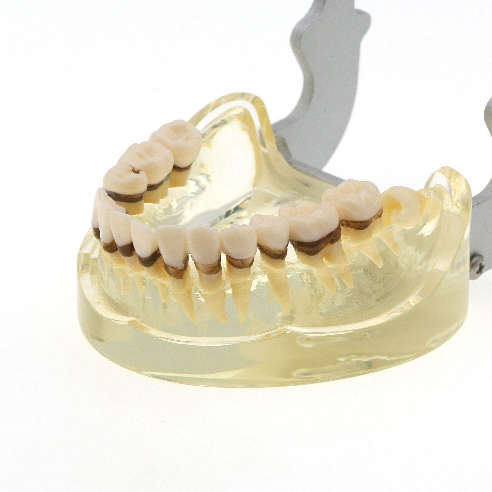 Dental Adult Periodontal Disease Pathological Teeth Typodont Model Removable Gum