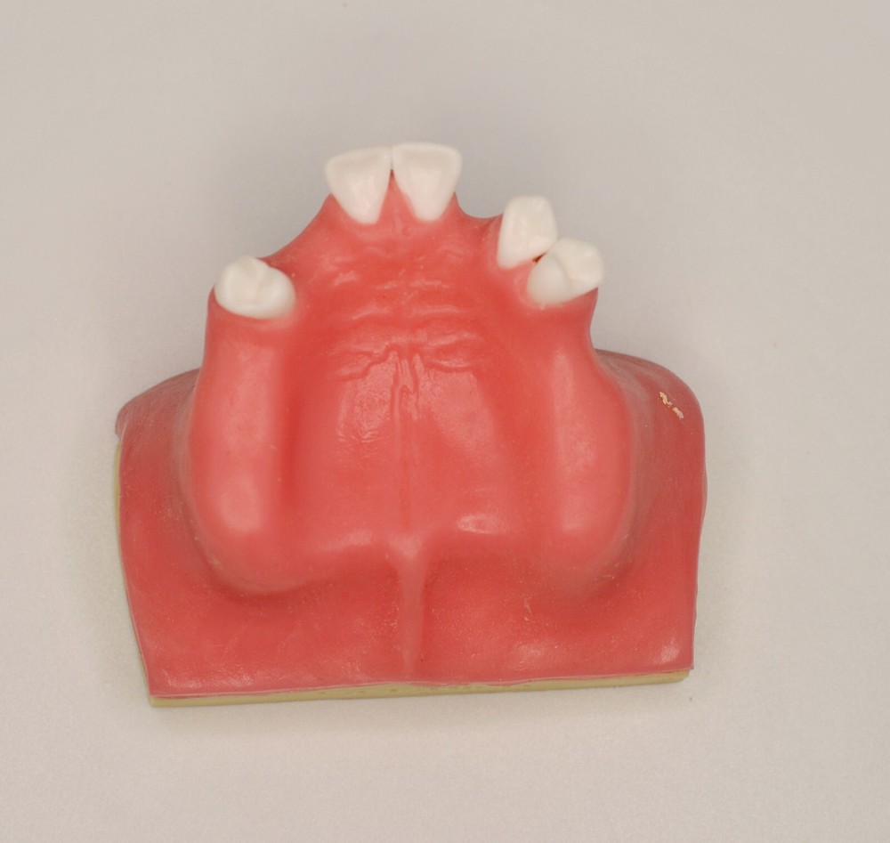 Dental Implant Model Maxillary Sinus Jaw Lift Practice Study Teeth Training