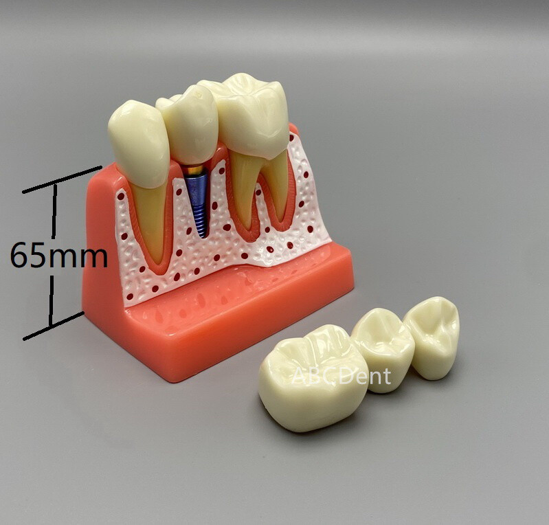 Dental Implant Teach Crown Bridge Analysis Removable Model Demonstration Study