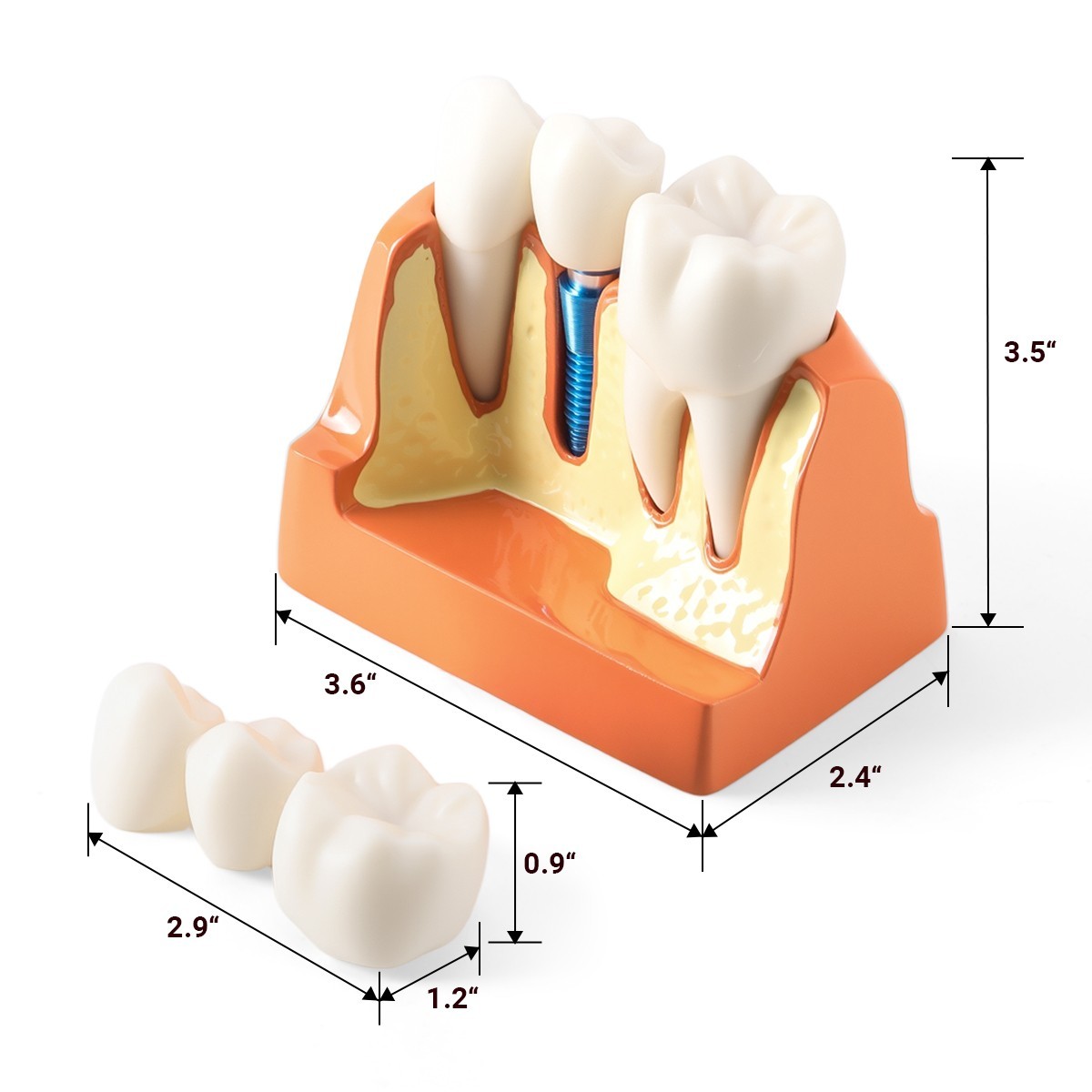 Dental 4 Times Teeth Model Implant Analysis Crown Bridge Demonstration Removable