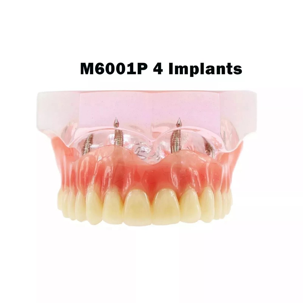 Dental Restoration Teeth Typodont Implants Model Demonstrate Overdenture 3 Model