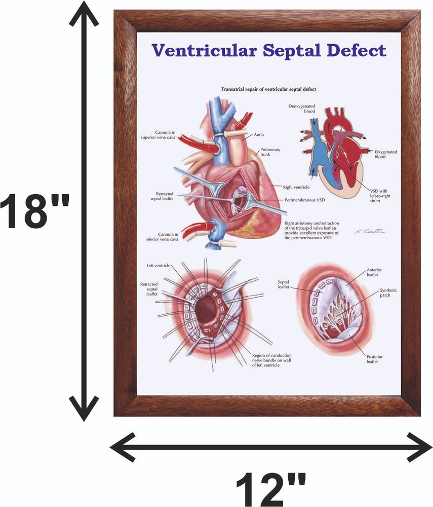 Ventricular Septal Defect Chart 12x18 inches