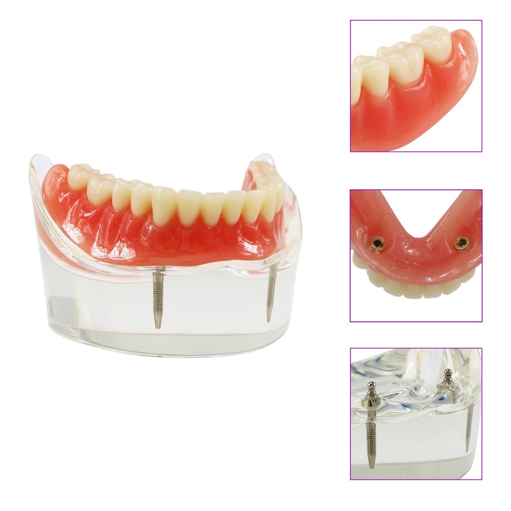 Implant Restoration Teeth Model Mandibular Overdenture with 2 Implants Dental