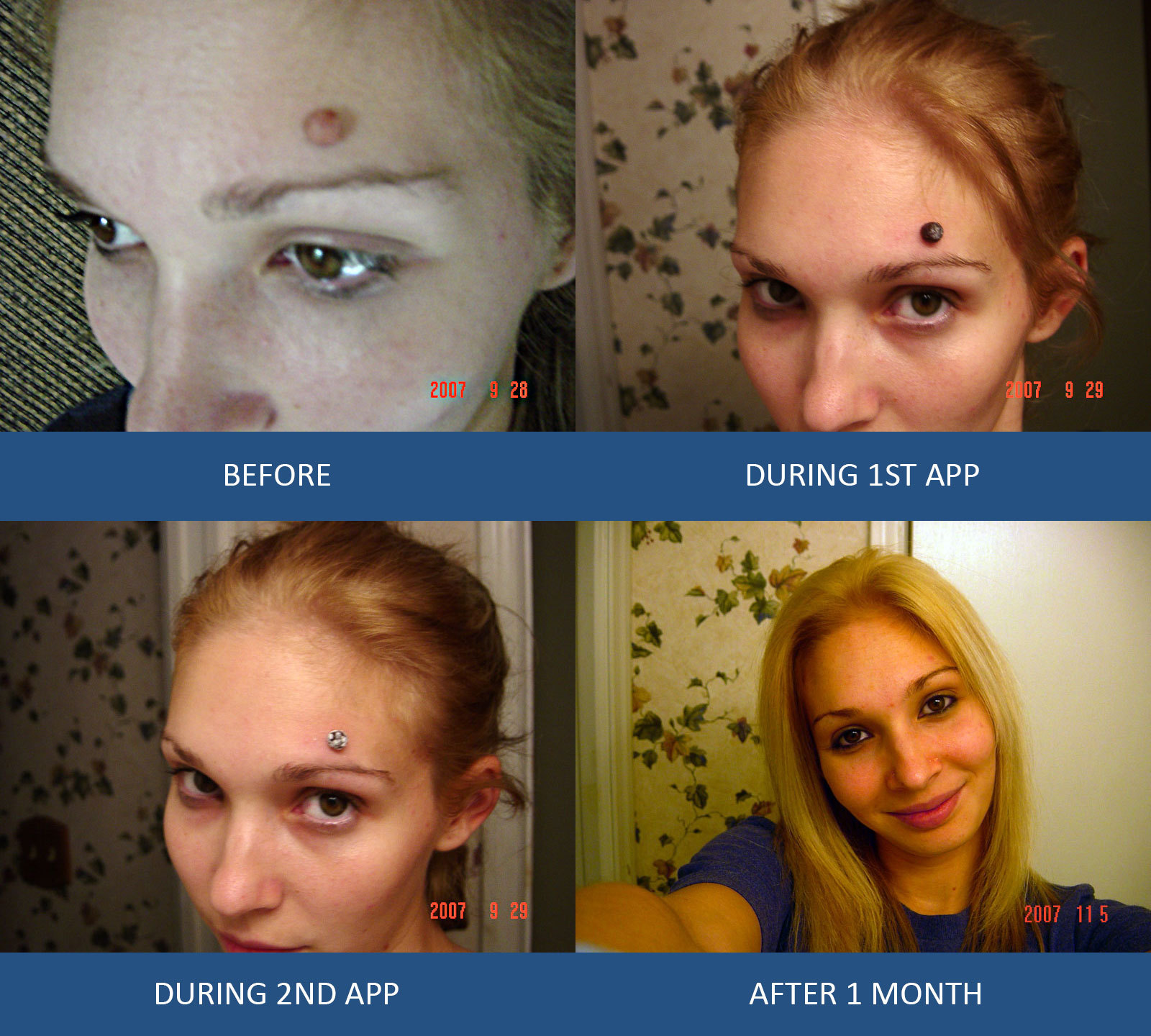 Mole Remover, Wart Remover, Skin Tag remover, Wart Mole Vanish™ Award Winning