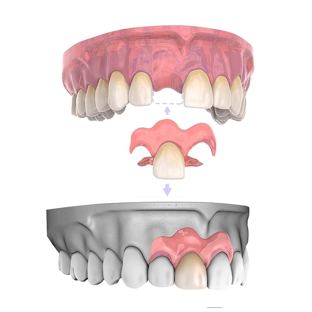 Partial Dentures for Women & Men, Custom Replacement Temporary Flipper Teeth ...