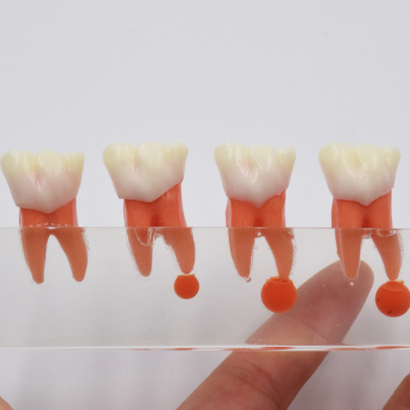 Dental Caries Disease M4018 Study Teaching Model Tooth Correcting Malocclusion