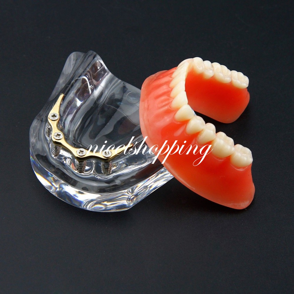 Dental Inferior Overdenture Model Lower Precision Implants With Silver Bar #6009