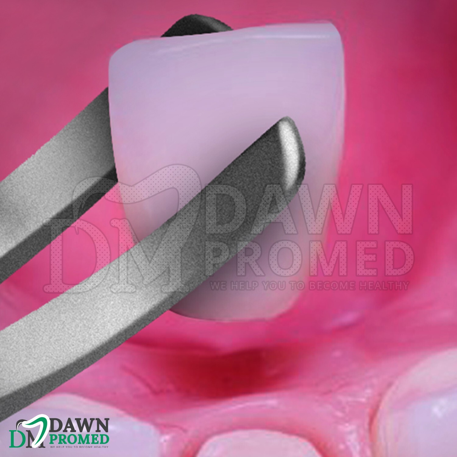 2 Pcs T/C Wynman Crown Remover & Gripper Forceps 7" Surgical Dental Instruments